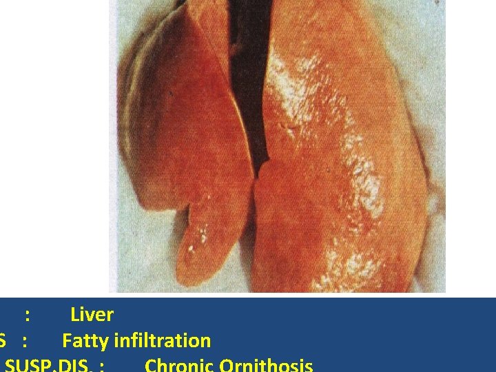 : S : Liver Fatty infiltration 