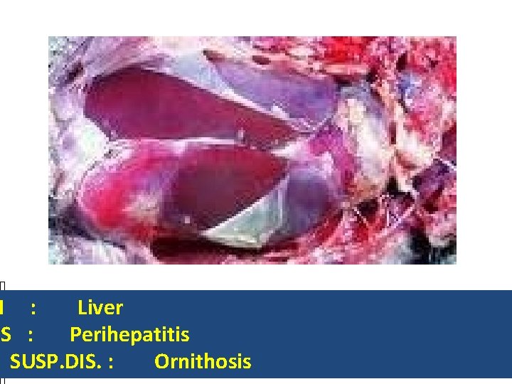 N : Liver NS : Perihepatitis SUSP. DIS. : Ornithosis 