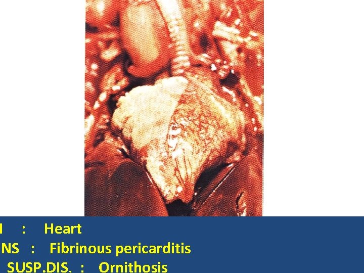 N : Heart ONS : Fibrinous pericarditis SUSP. DIS. : Ornithosis 