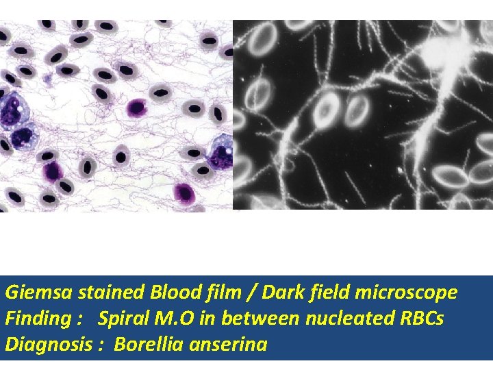 Giemsa stained Blood film / Dark field microscope Finding : Spiral M. O in