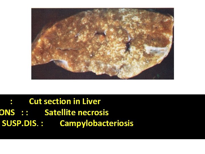 : Cut section in Liver ONS : : Satellite necrosis SUSP. DIS. : Campylobacteriosis