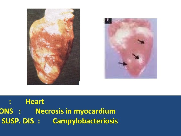: Heart ONS : Necrosis in myocardium SUSP. DIS. : Campylobacteriosis 