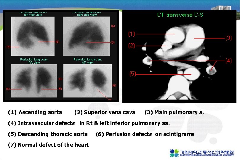 (1) Ascending aorta (2) Superior vena cava (3) Main pulmonary a. (4) Intravascular defects