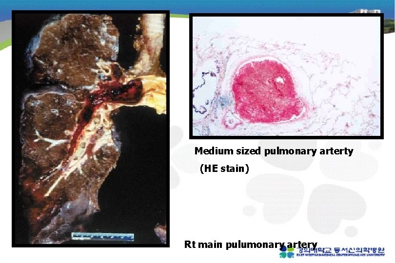 Medium sized pulmonary arterty (HE stain) Rt main pulumonary artery 