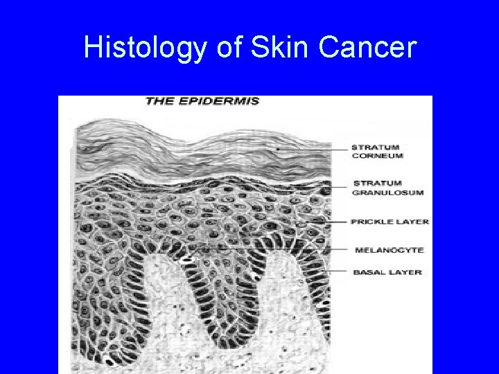 Histology of Skin Cancer 