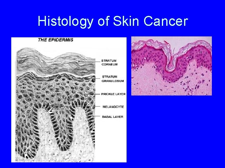 Histology of Skin Cancer 