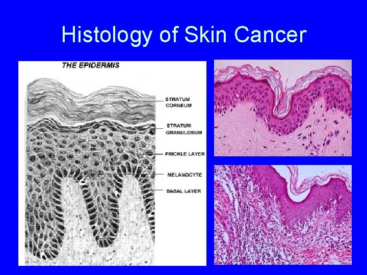 Histology of Skin Cancer 