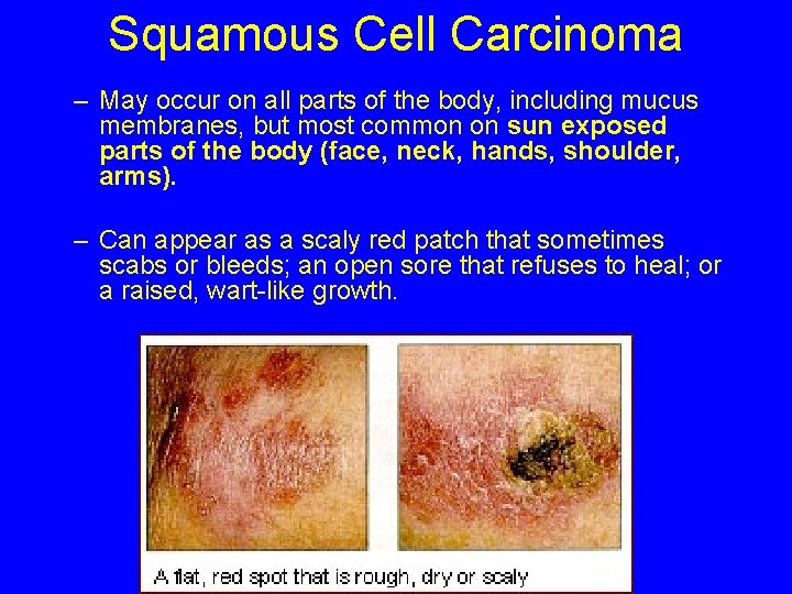 Squamous Cell Carcinoma – May occur on all parts of the body, including mucus