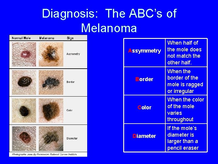 Diagnosis: The ABC’s of Melanoma Assymmetry When half of the mole does not match