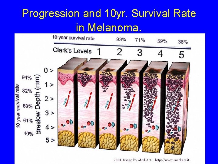 Progression and 10 yr. Survival Rate in Melanoma. 