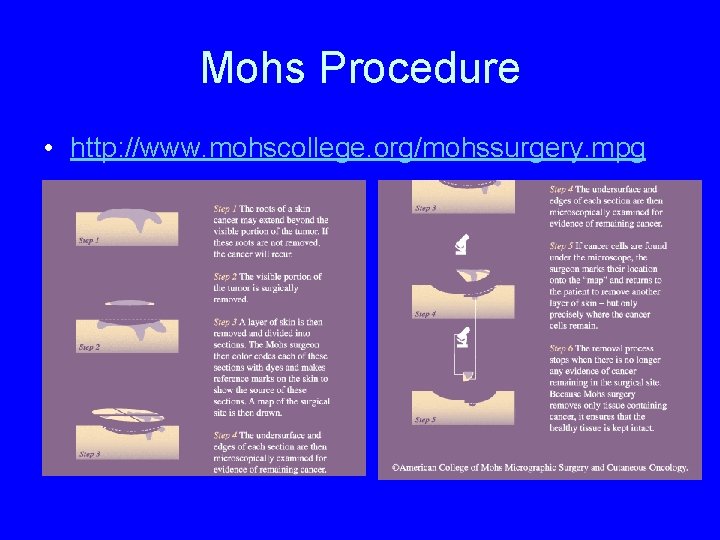 Mohs Procedure • http: //www. mohscollege. org/mohssurgery. mpg 