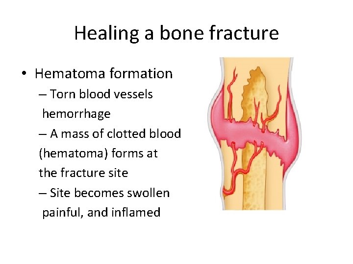 Healing a bone fracture • Hematoma formation – Torn blood vessels hemorrhage – A