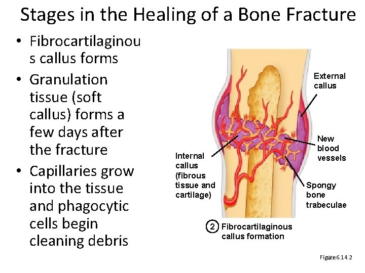 Stages in the Healing of a Bone Fracture • Fibrocartilaginou s callus forms •