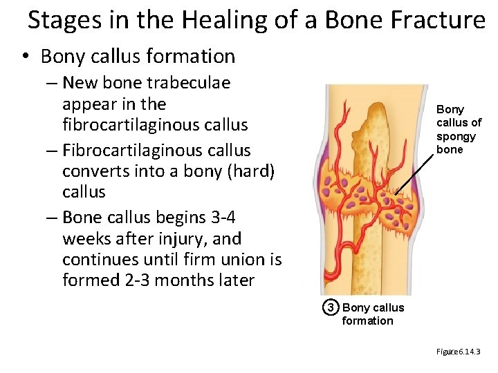 Stages in the Healing of a Bone Fracture • Bony callus formation – New