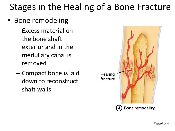 Stages in the Healing of a Bone Fracture • Bone remodeling – Excess material