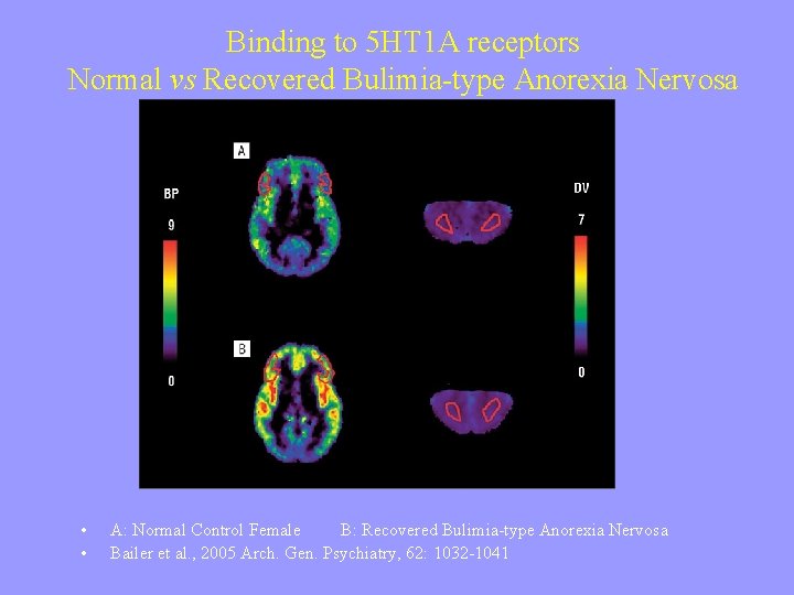 Binding to 5 HT 1 A receptors Normal vs Recovered Bulimia-type Anorexia Nervosa •