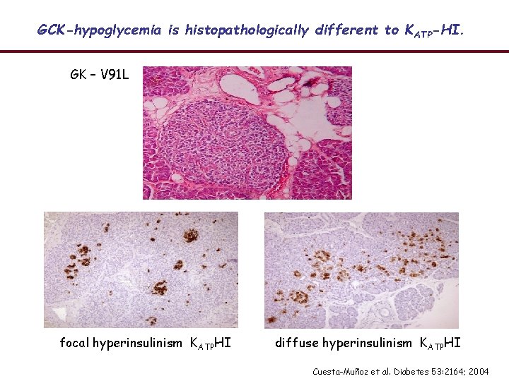 GCK-hypoglycemia is histopathologically different to K ATP-HI. GK – V 91 L 120 mm