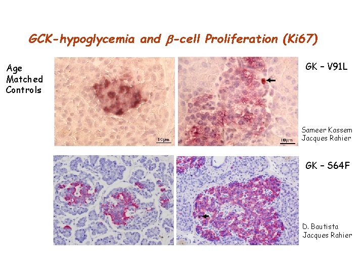 GCK-hypoglycemia and -cell Proliferation (Ki 67) Age Matched Controls GK – V 91 L