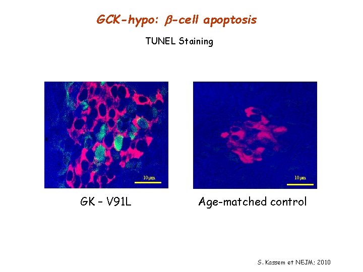 GCK-hypo: -cell apoptosis TUNEL Staining 10 m GK – V 91 L 10 m