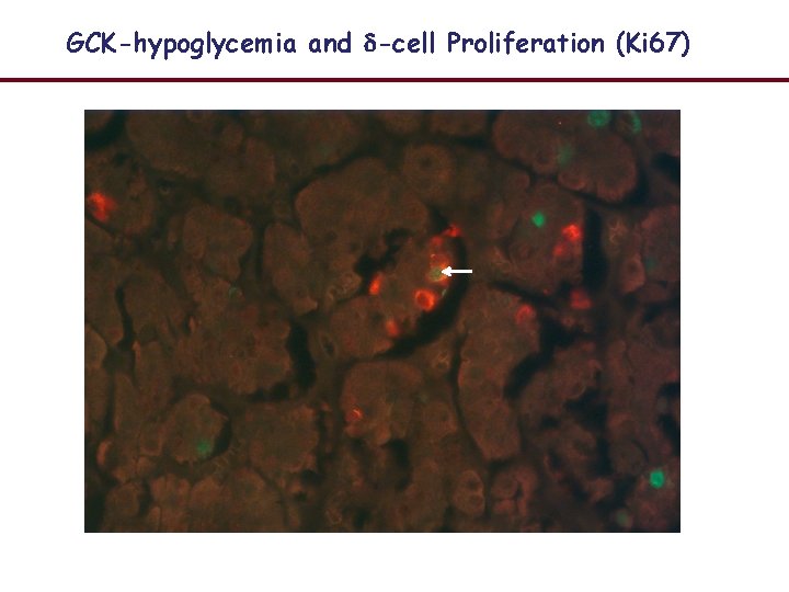 GCK-hypoglycemia and -cell Proliferation (Ki 67) 