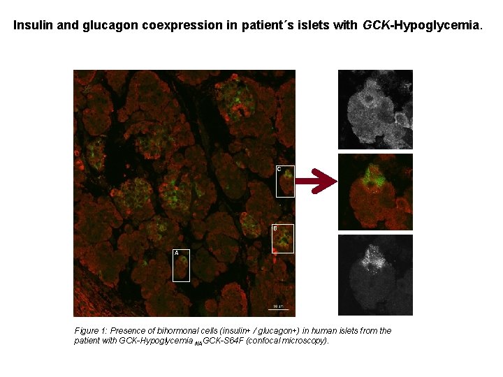 Insulin and glucagon coexpression in patient´s islets with GCK-Hypoglycemia. C C B A Figure