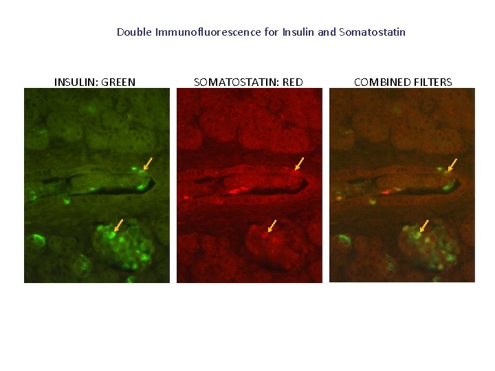 Double Immunofluorescence for Insulin and Somatostatin INSULIN: GREEN SOMATOSTATIN: RED COMBINED FILTERS 