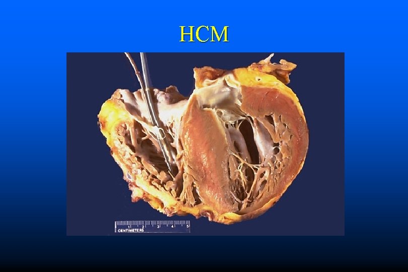 HCM 