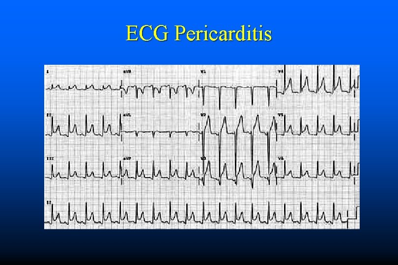 ECG Pericarditis 