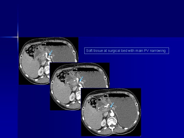 Soft tissue at surgical bed with main PV narrowing 