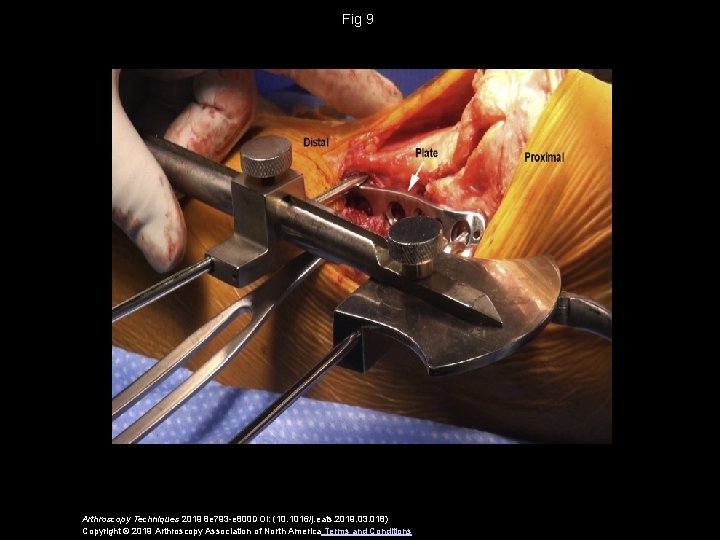 Fig 9 Arthroscopy Techniques 2019 8 e 793 -e 800 DOI: (10. 1016/j. eats.