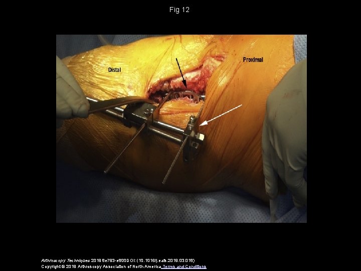 Fig 12 Arthroscopy Techniques 2019 8 e 793 -e 800 DOI: (10. 1016/j. eats.