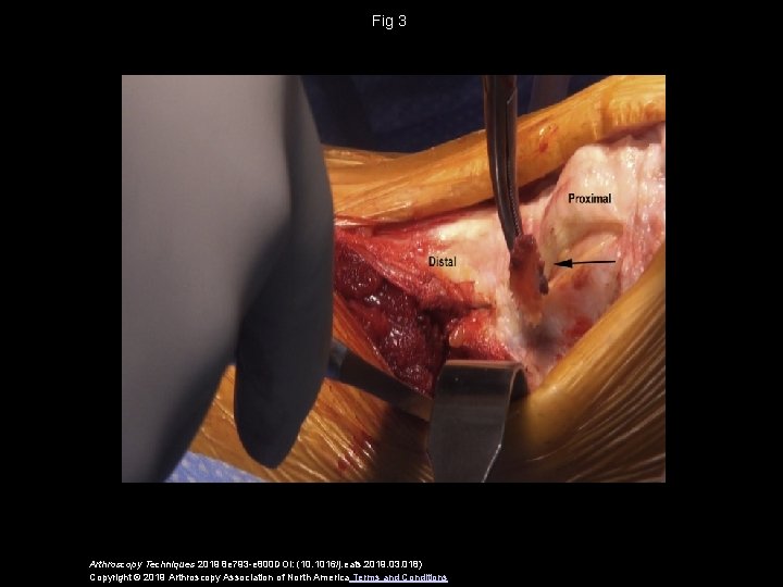 Fig 3 Arthroscopy Techniques 2019 8 e 793 -e 800 DOI: (10. 1016/j. eats.