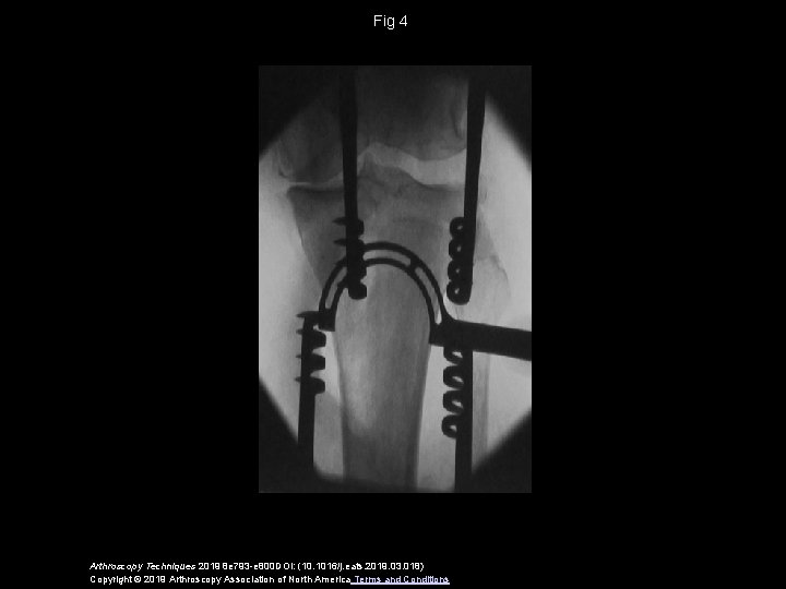 Fig 4 Arthroscopy Techniques 2019 8 e 793 -e 800 DOI: (10. 1016/j. eats.