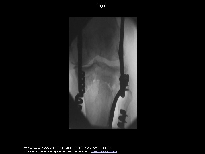 Fig 6 Arthroscopy Techniques 2019 8 e 793 -e 800 DOI: (10. 1016/j. eats.