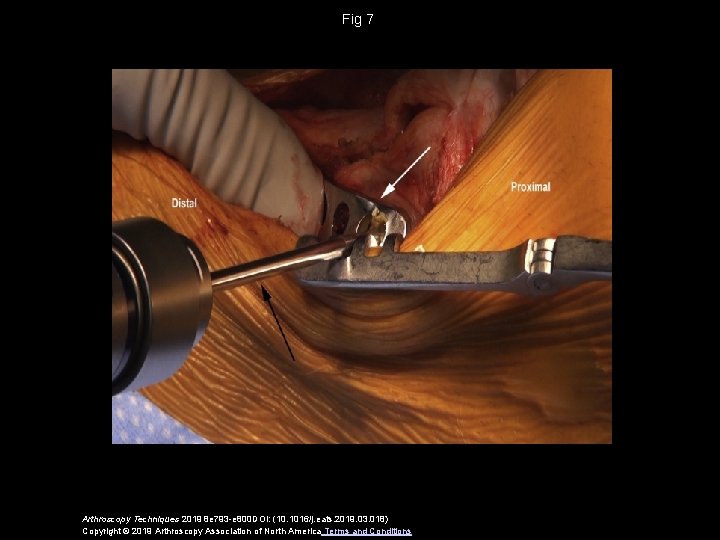 Fig 7 Arthroscopy Techniques 2019 8 e 793 -e 800 DOI: (10. 1016/j. eats.