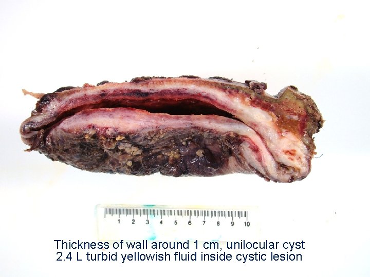 Thickness of wall around 1 cm, unilocular cyst 2. 4 L turbid yellowish fluid