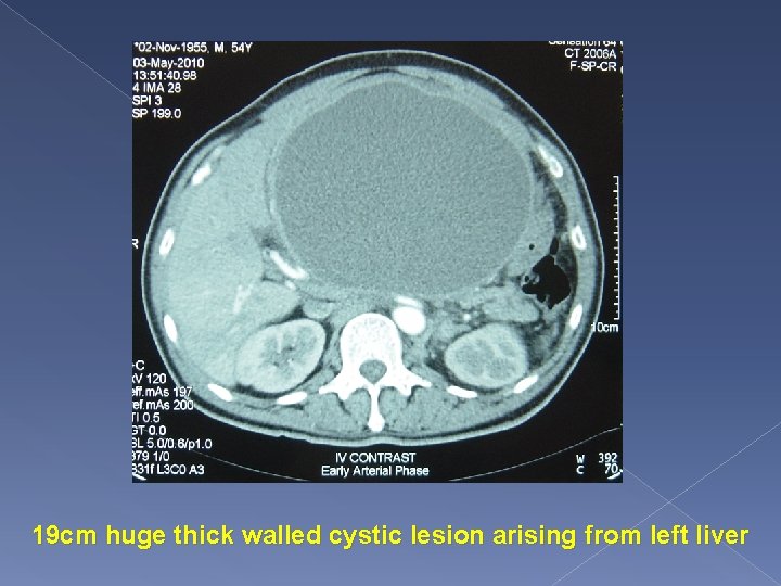 19 cm huge thick walled cystic lesion arising from left liver 