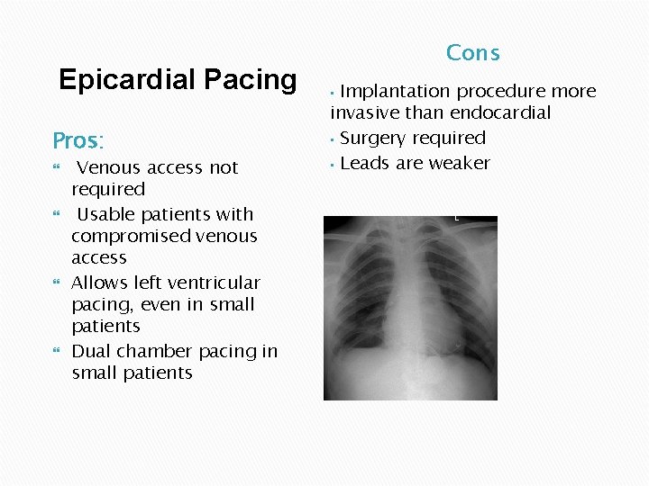 Epicardial Pacing Pros: Venous access not required Usable patients with compromised venous access Allows