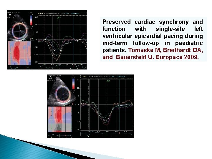 Preserved cardiac synchrony and function with single-site left ventricular epicardial pacing during mid-term follow-up