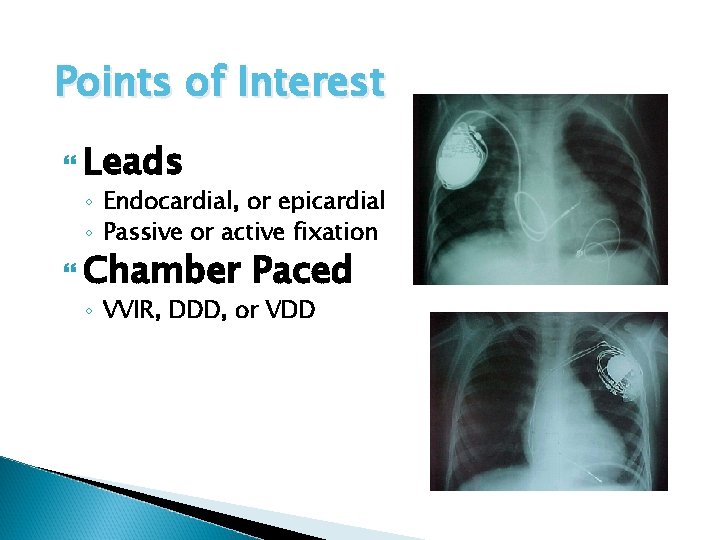 Points of Interest Leads ◦ Endocardial, or epicardial ◦ Passive or active fixation Chamber