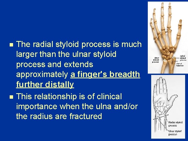 n n The radial styloid process is much larger than the ulnar styloid process