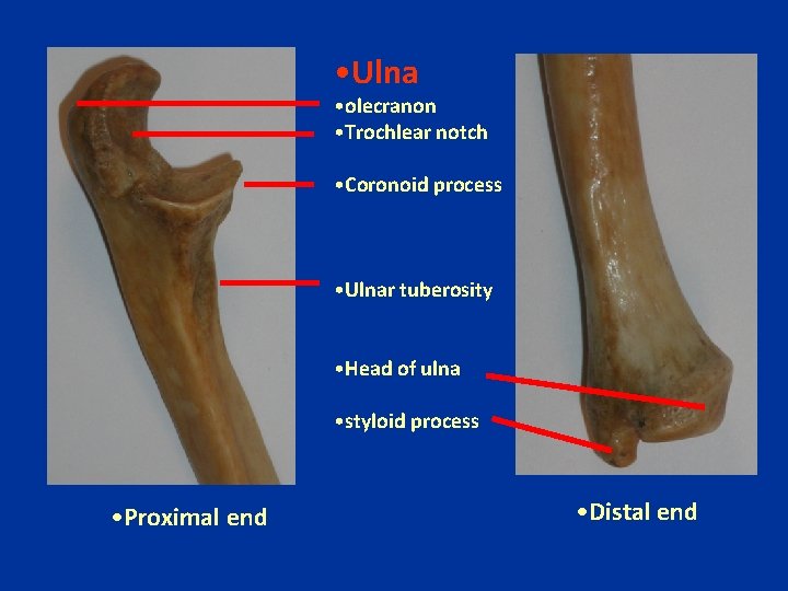  • Ulna • olecranon • Trochlear notch • Coronoid process • Ulnar tuberosity