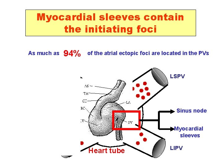 Myocardial sleeves contain the initiating foci As much as 94% of the atrial ectopic