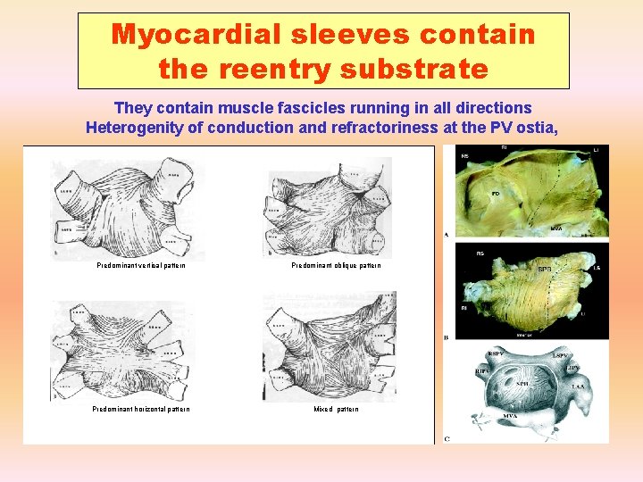 Myocardial sleeves contain the reentry substrate They contain muscle fascicles running in all directions