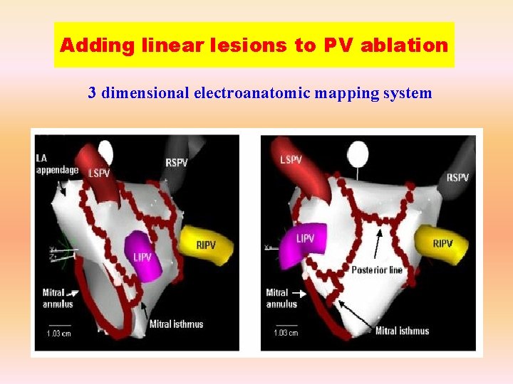 Adding linear lesions to PV ablation 3 dimensional electroanatomic mapping system 