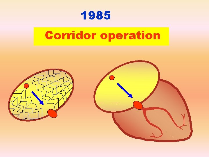 1985 Corridor operation 