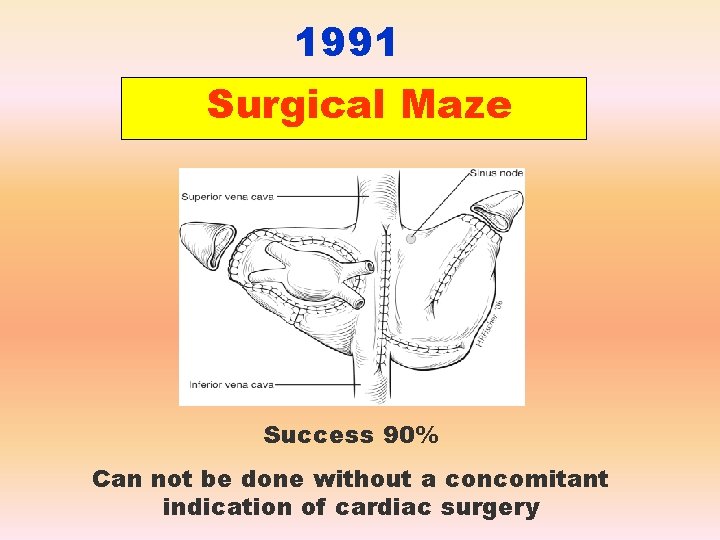 1991 Surgical Maze Success 90% Can not be done without a concomitant indication of