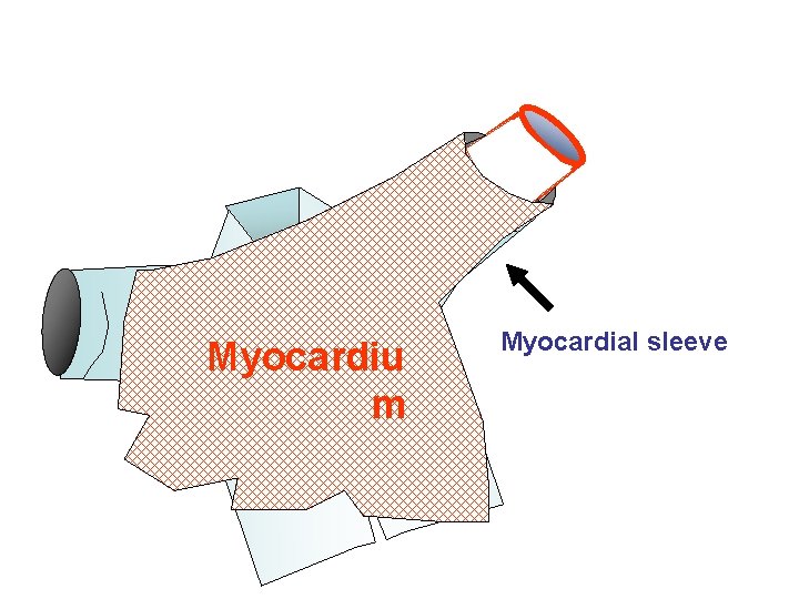 PV LA Myocardiu m Myocardial sleeve 