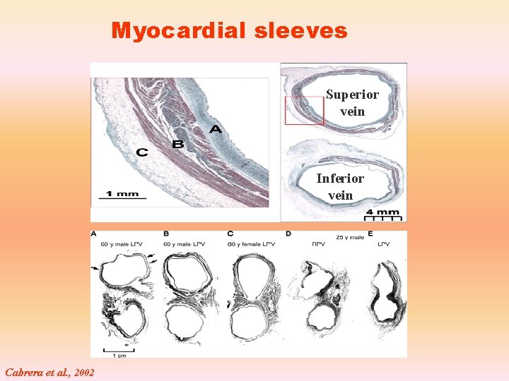 Myocardial sleeves Superior vein Inferior vein Cabrera et al. , 2002 