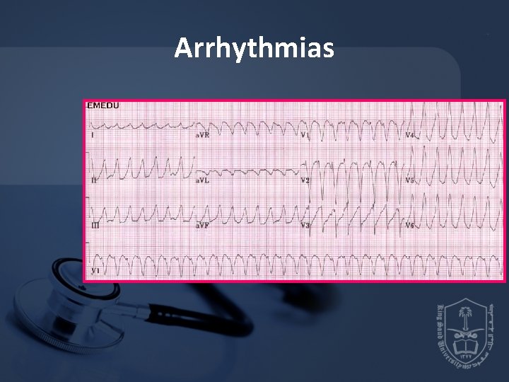 Arrhythmias 